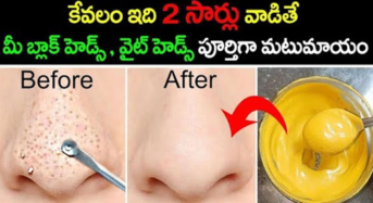 Blackheads : కేవలం 2 సార్లు వాడితే చాలు.. మీ బ్లాక్ హెడ్స్ వైట్ హెడ్స్ పూర్తిగా మటుమాయం…!