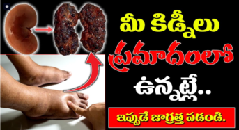 Kidney Failure : మీ కిడ్నీలు ప్రమాదంలో ఉన్నాయని తెలిపే లక్షణాలు ఇవే…!